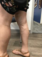 Mrn 259206 pre op image