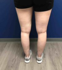 BEFORE AFTER EMILY KOTCH B