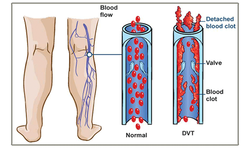 Deep vein thrombosis