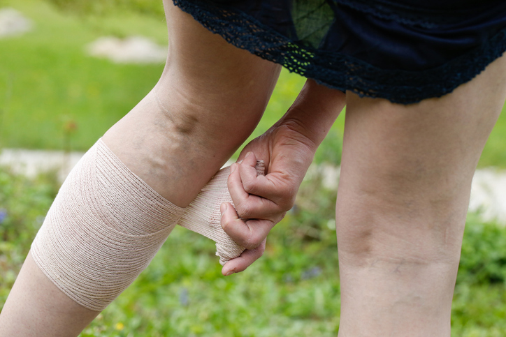 Woman with varicose veins applying