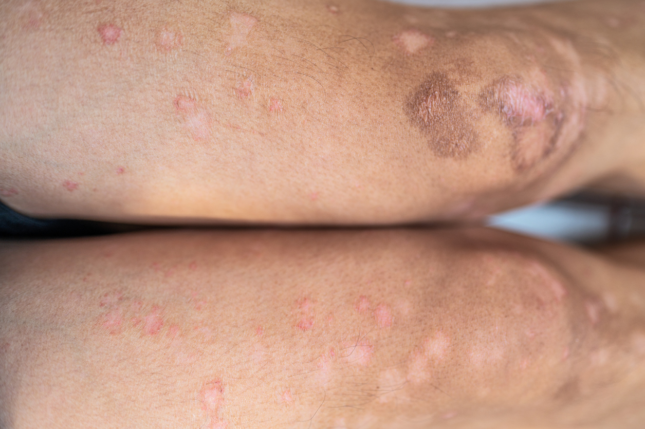 Varicoză eczema