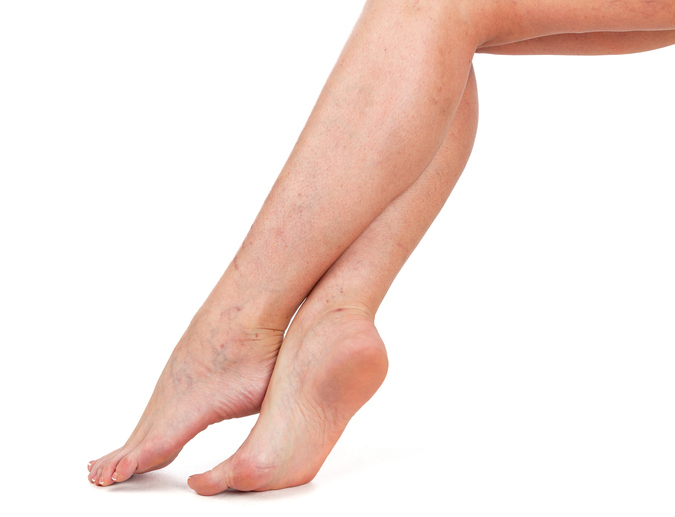 Legs of Woman with Vascular Stars