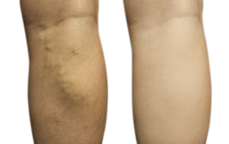 Female leg varicose veins before and after treatment stock photo
