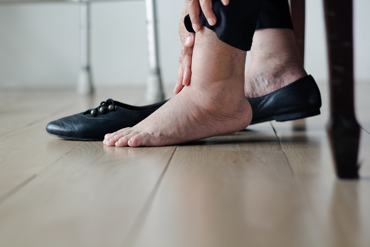 Elderly woman swollen feet