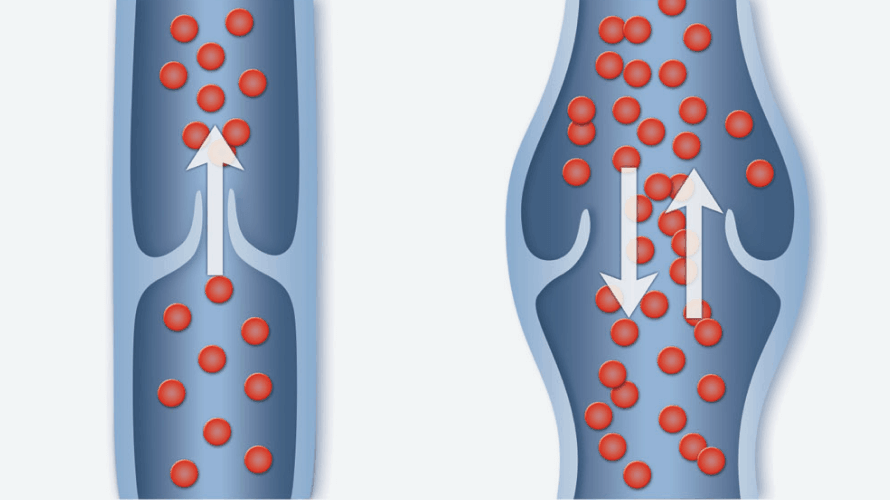 Inline vein diagram