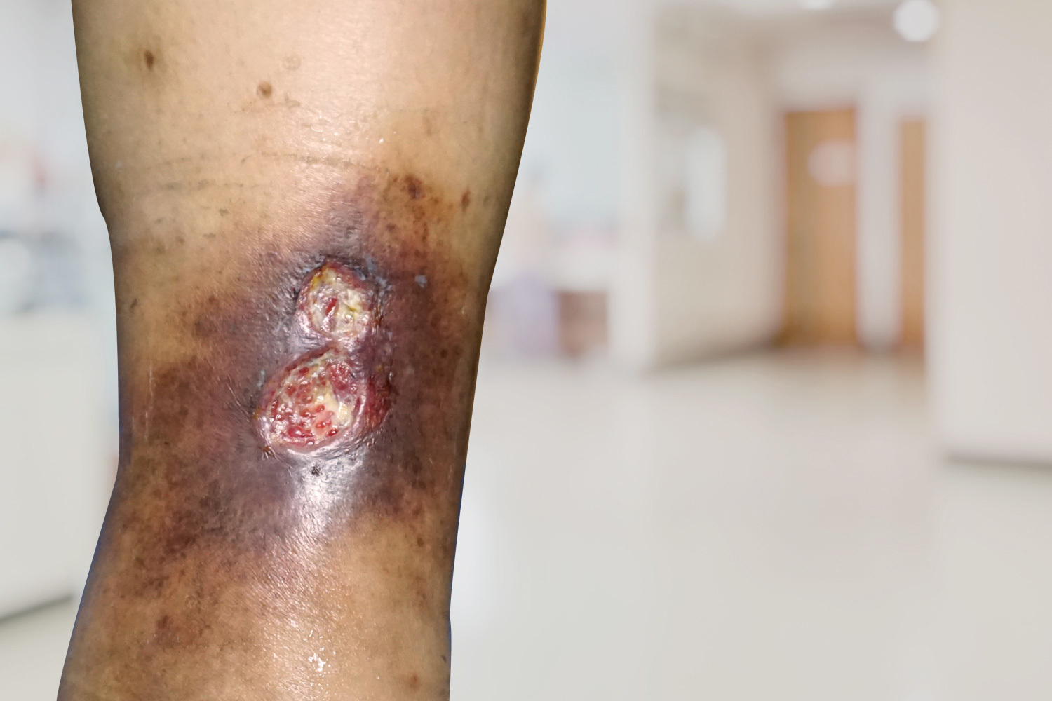 hoja Deflector Seguro Center for Vein Restoration | ¿Los especialistas en venas son más efectivos en tiempo y costo para la curación de las… hoja Deflector Seguro Center for Vein Restoration | ¿Los especialistas en venas son más efectivos en tiempo y costo para la curación de las…