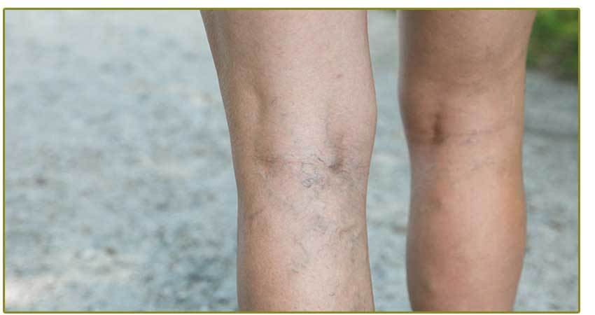 Spider vein legs