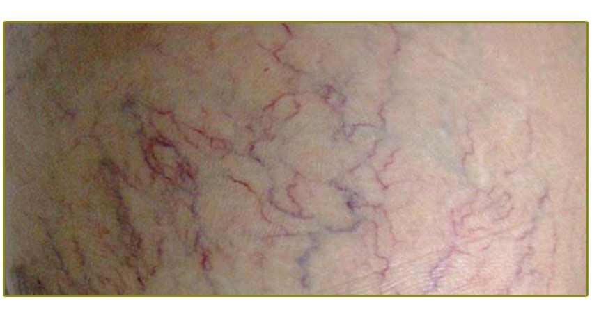 Spider veins