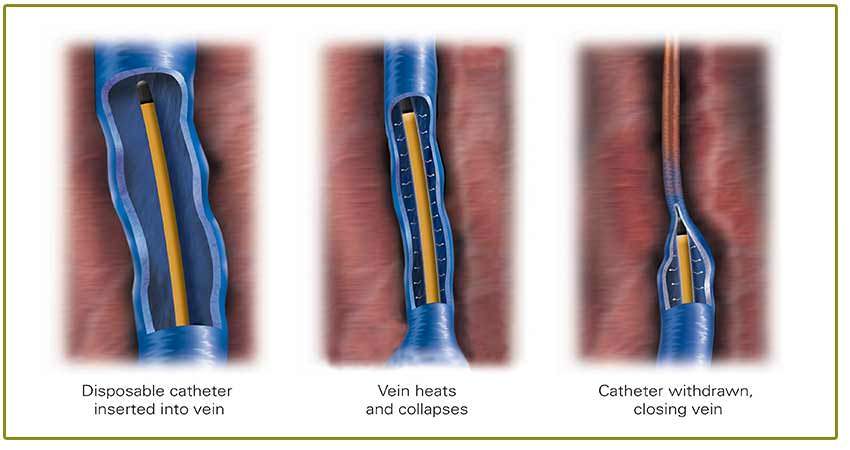 Thermal ablation