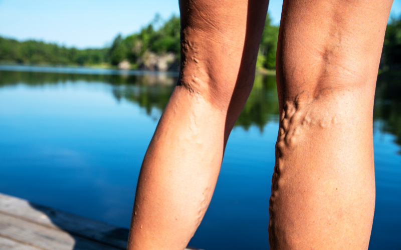 Treatment options to get rid of varicose veins