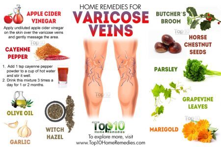 Varicose veins 1 450x300