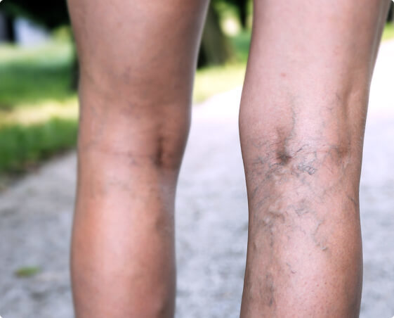 Varicose veins