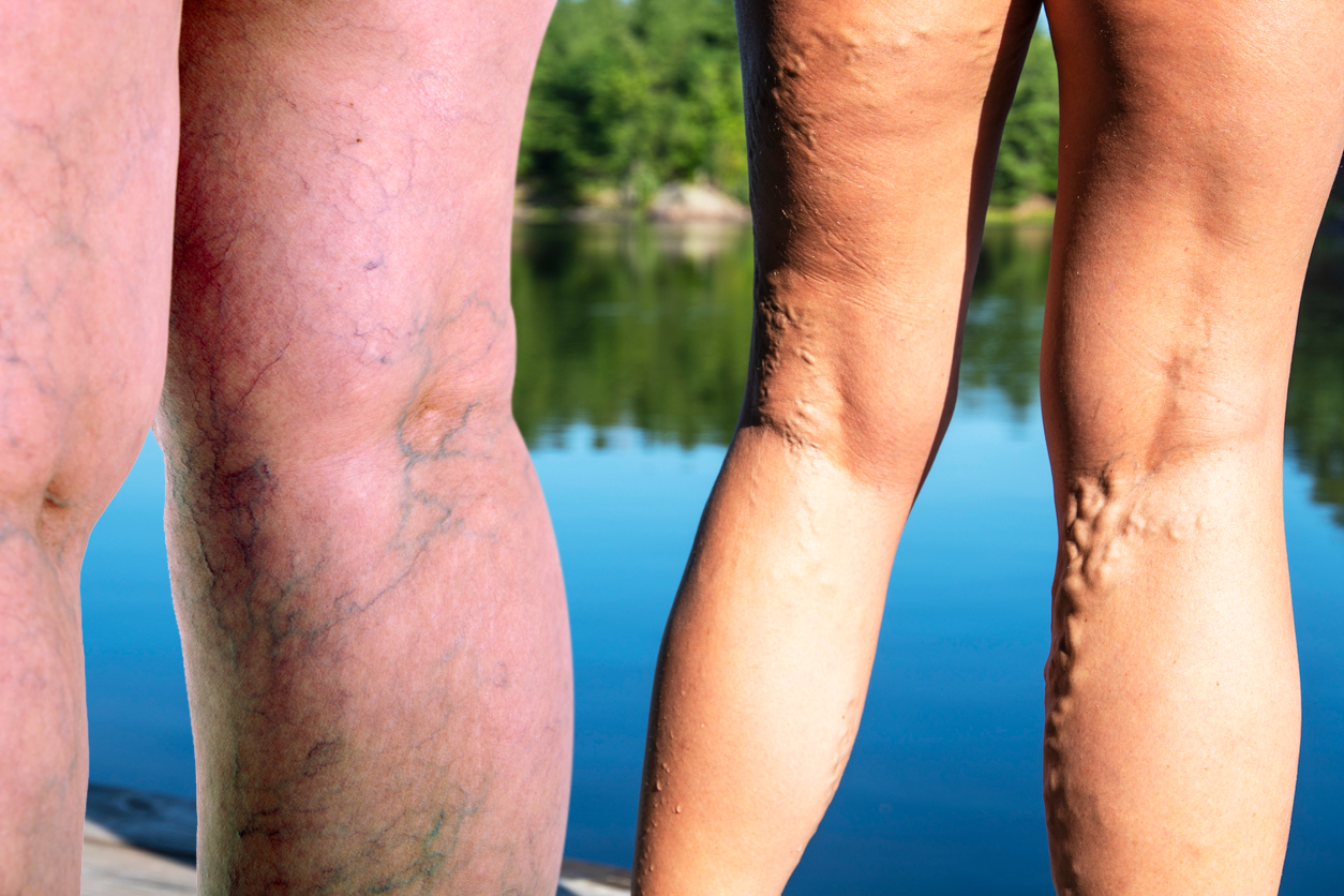 Is Restless Leg Syndrome (RLS) a Symptom of Varicose Veins?