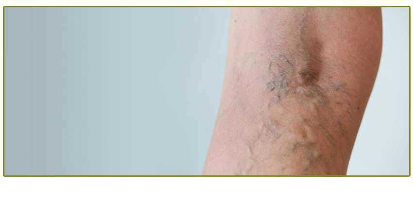 Vein disease 190904 195447