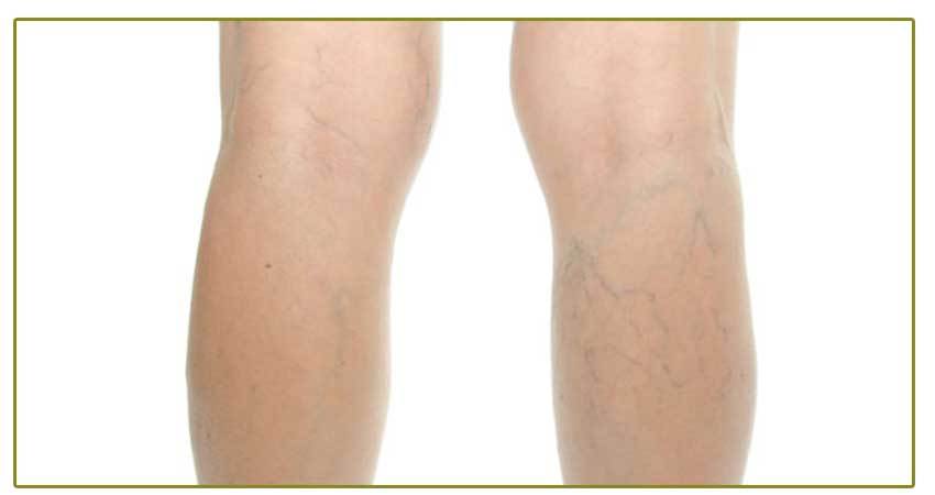 Vein disease