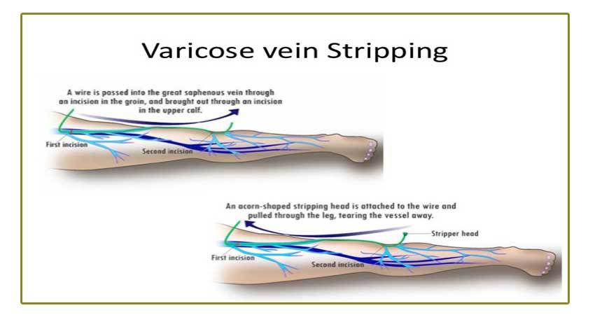 Vein stripping