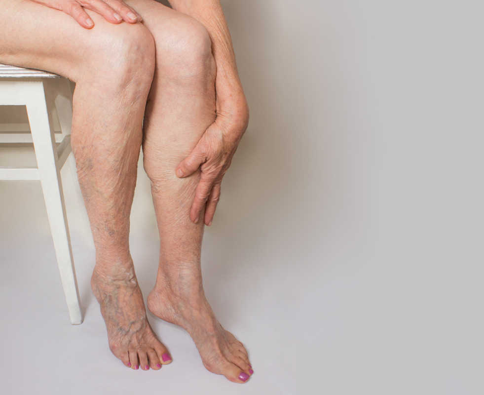 Varicose Veins in Feet and Ankles, Symptoms and Treatment