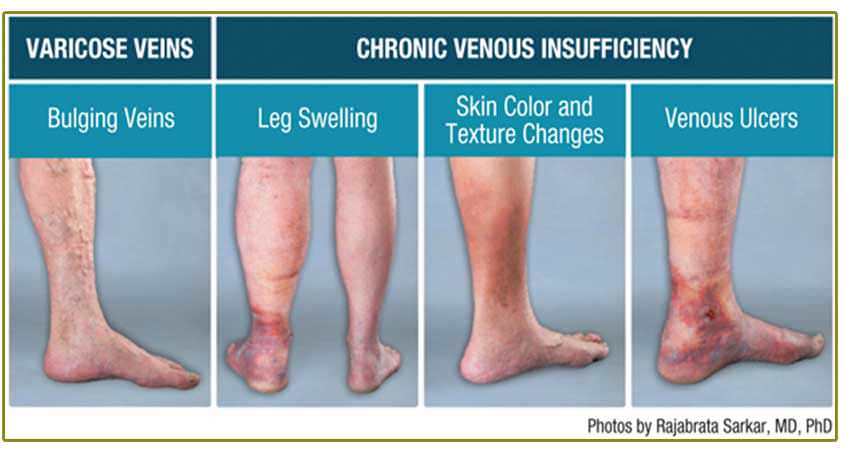 venous stasis signs